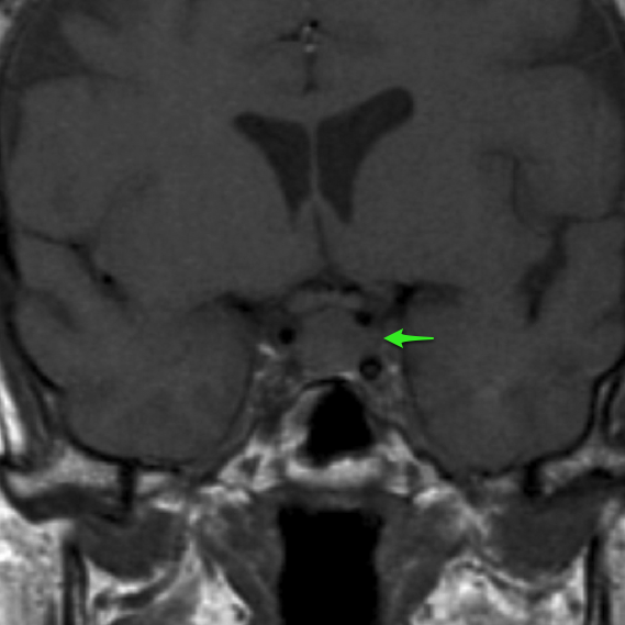 Pituitary metastasis | Image | Radiopaedia.org