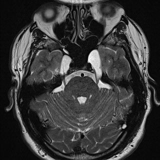 Petrous apex cephalocele | Image | Radiopaedia.org