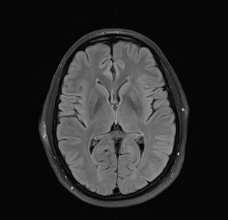 Petrous apex cephalocele | Image | Radiopaedia.org