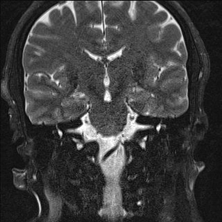 Petrous apex cephalocele | Image | Radiopaedia.org