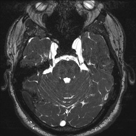 Petrous apex cephalocele | Image | Radiopaedia.org