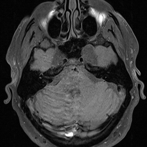 Petrous apex cephalocele | Image | Radiopaedia.org