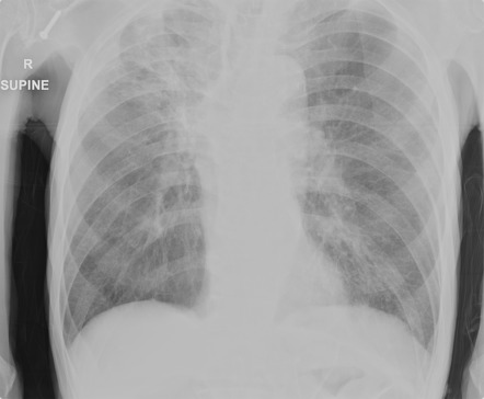 Small cell lung carcinoma | Image | Radiopaedia.org