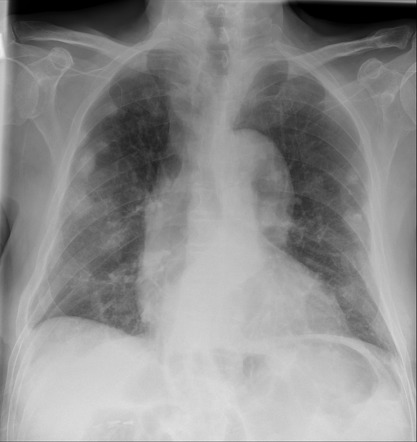 Pleural plaque | Radiology Reference Article | Radiopaedia.org