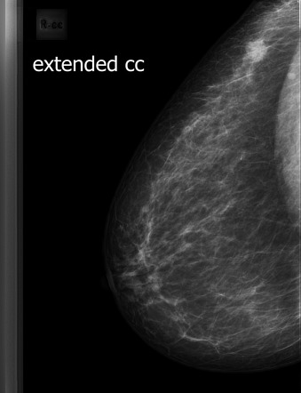 Comparison of the breast mass with the craniocaudal (CC) and