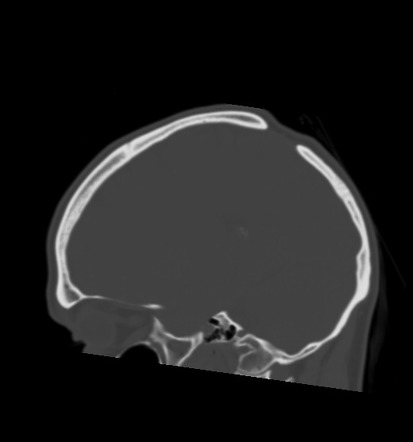 Parietal foramina | Radiology Reference Article | Radiopaedia.org