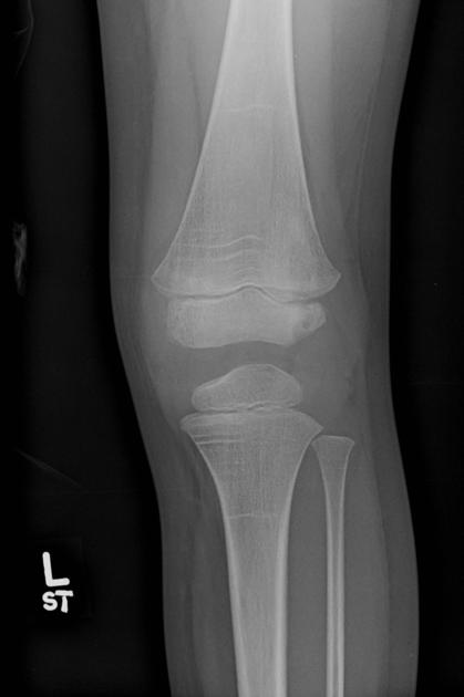 Osteomyelitis | Radiology Reference Article | Radiopaedia.org