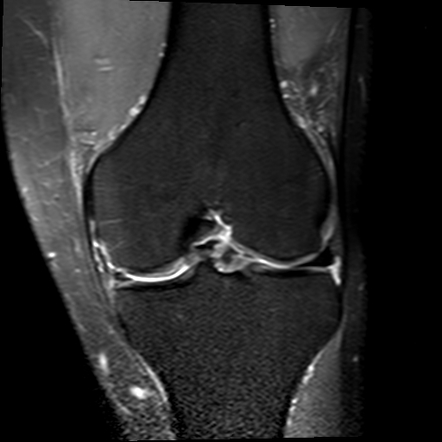 Bucket-handle tear | Image | Radiopaedia.org