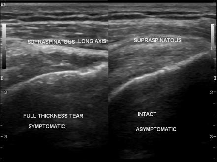 Supraspinatus Tendon Tear Radiology Case Radiopaedia Org