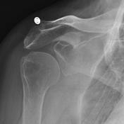 Tag: rotator cuff | Radiopaedia.org