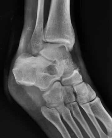 Broden's view | Radiology Reference Article | Radiopaedia.org