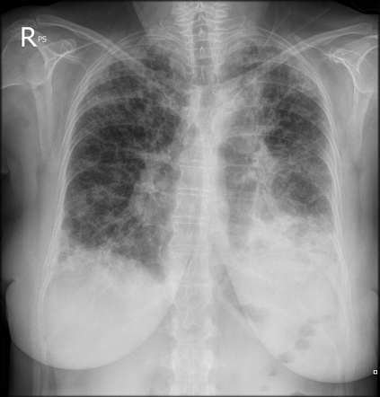 Eosinophilic lung disease - chronic | Radiology Case | Radiopaedia.org