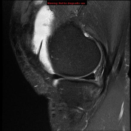 Medial patellar plica syndrome | Image | Radiopaedia.org