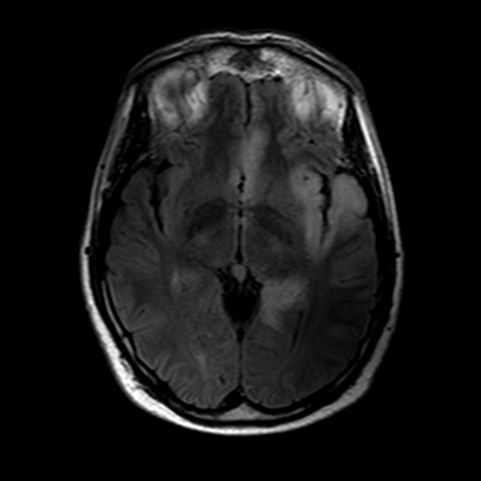 BRAIN, Gyriform Enhancement | Playlist | Radiopaedia.org