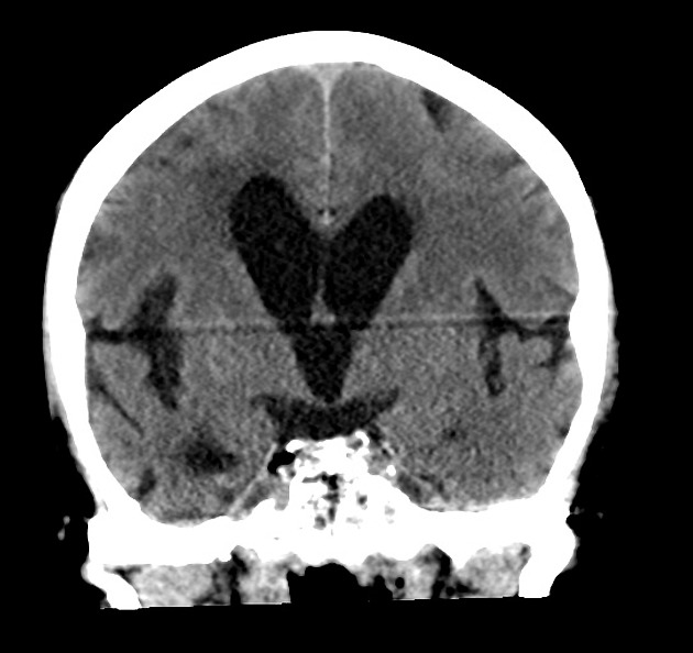 Callosal angle | Radiology Reference Article | Radiopaedia.org