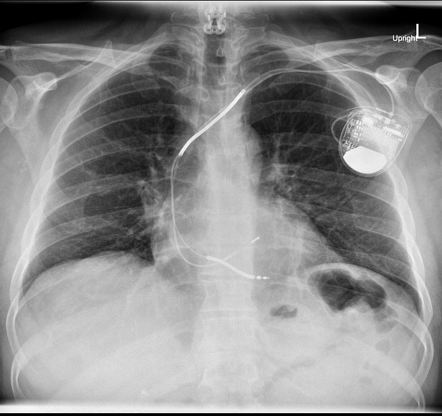 Medtronic Chronicle lead | Radiology Case | Radiopaedia.org