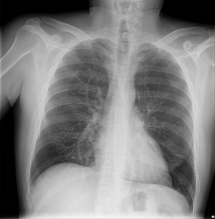 Pneumothorax: inspiratory and expiratory x-rays | Radiology Case ...