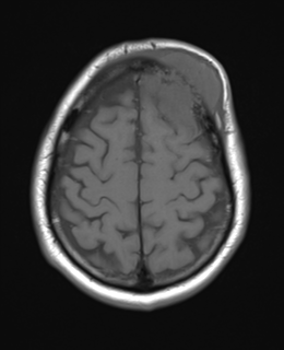 Skull metastasis from lung | Image | Radiopaedia.org