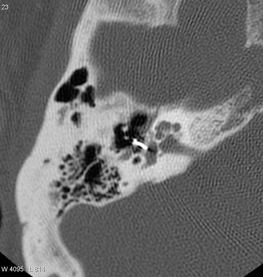 Stapes prosthesis dislocation - Siemens Healthineers USA