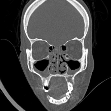 Granulomatosis with polyangiitis (upper respiratory tract ...