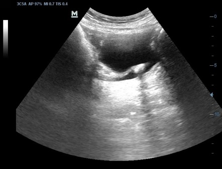 Vesico-ureteric Junction Stone 