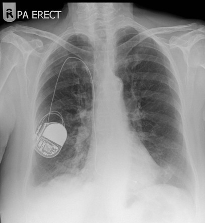 Right sided pacemaker | Radiology Case | Radiopaedia.org