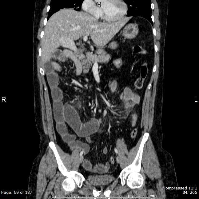 Left-sided Appendicitis In Intestinal Malrotation | Image | Radiopaedia.org