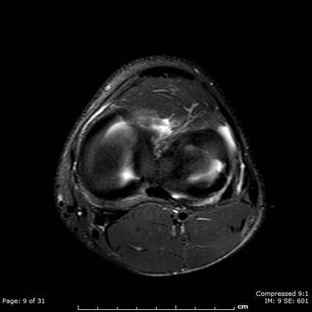 Radial meniscal tear | Radiology Reference Article | Radiopaedia.org