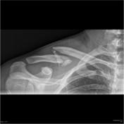 clavicle fracture classification