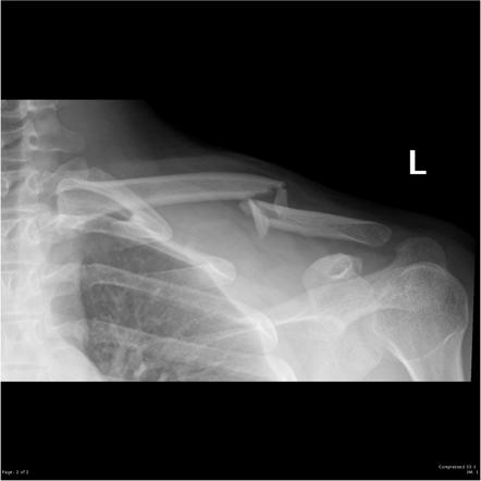 Clavicle (AP cephalic view) | Radiology Reference Article | Radiopaedia.org