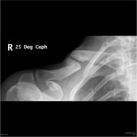 Clavicular fracture | Radiology Reference Article | Radiopaedia.org