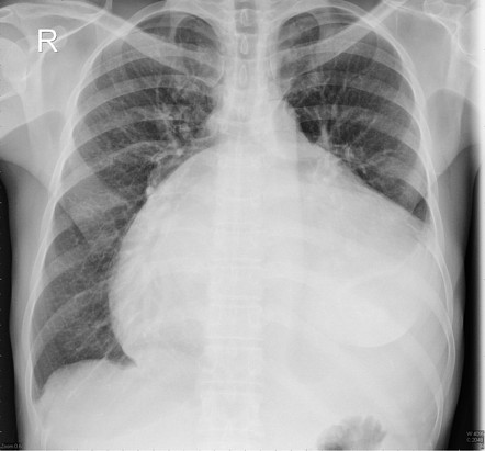 Ebstein anomaly | Radiology Reference Article | Radiopaedia.org