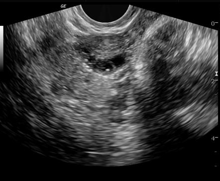 Echogenic ovarian foci | Image | Radiopaedia.org