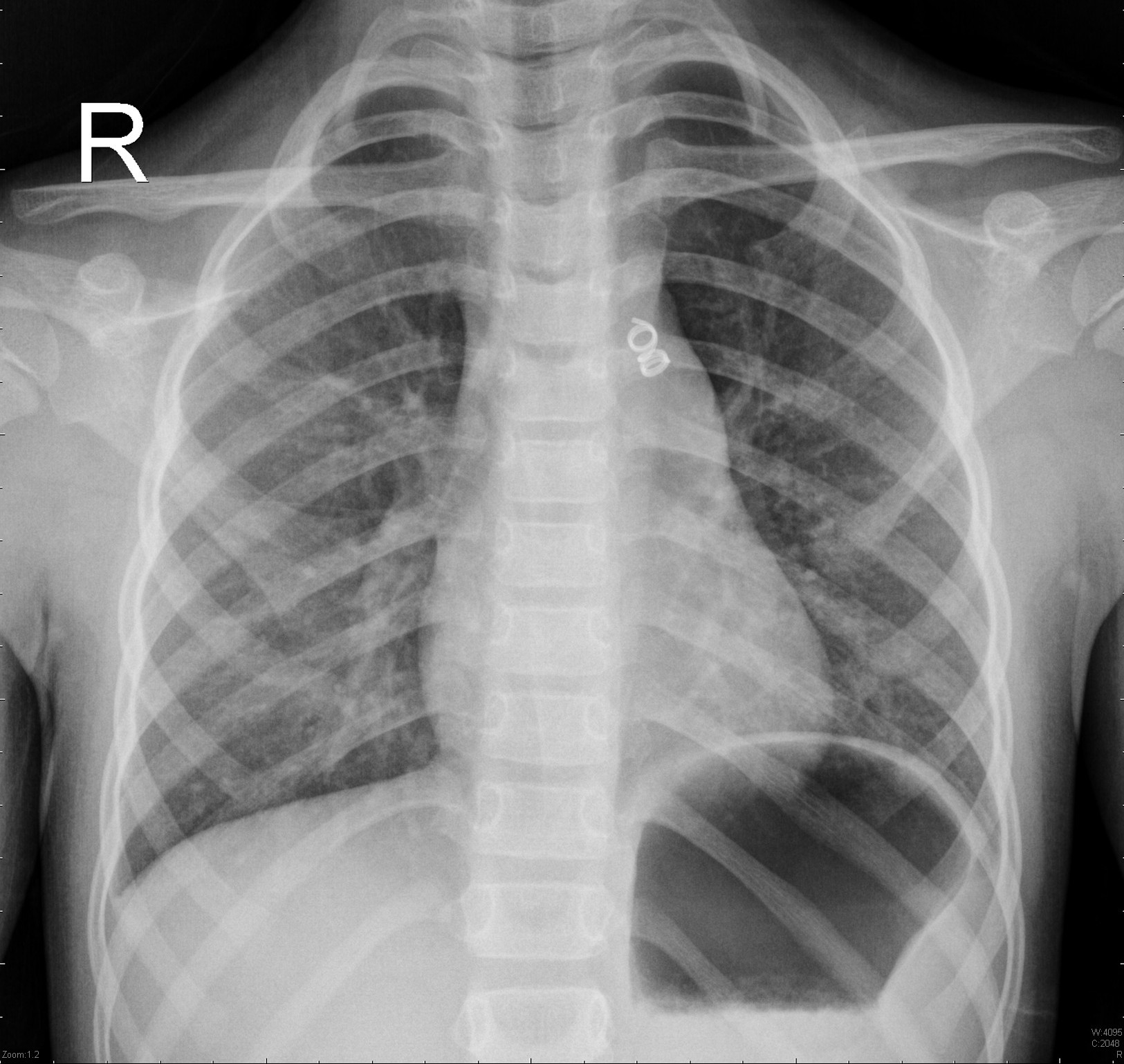 Transcatheter Closure Of Patent Ductus Arteriosus | Image | Radiopaedia.org