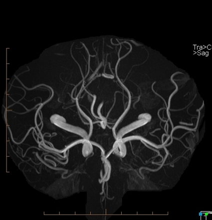 Reversible cerebral vasoconstriction syndrome | Image | Radiopaedia.org