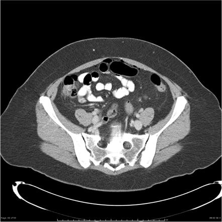 Viewing playlist: Acute abdomen (iOS pack) | Radiopaedia.org