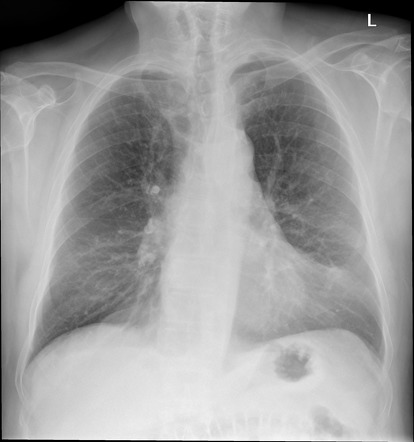 Pericardial fat pads | Radiology Case | Radiopaedia.org