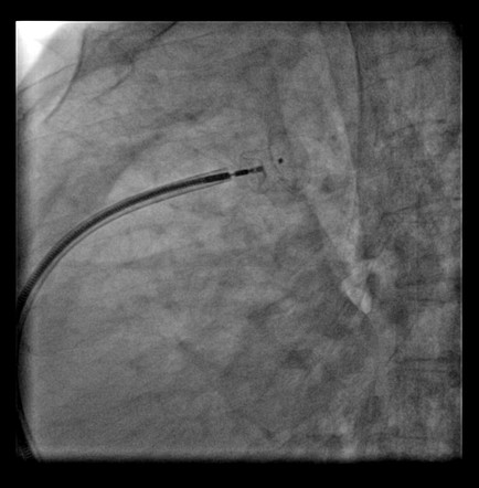 Transcatheter closure of patent ductus arteriosus | Image | Radiopaedia.org