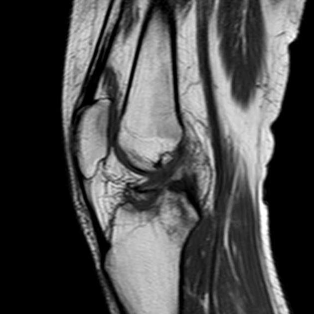 Anterior Cruciate Ligament Avulsion Fracture Radiology