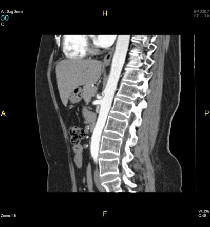 Median arcuate ligament syndrome что это