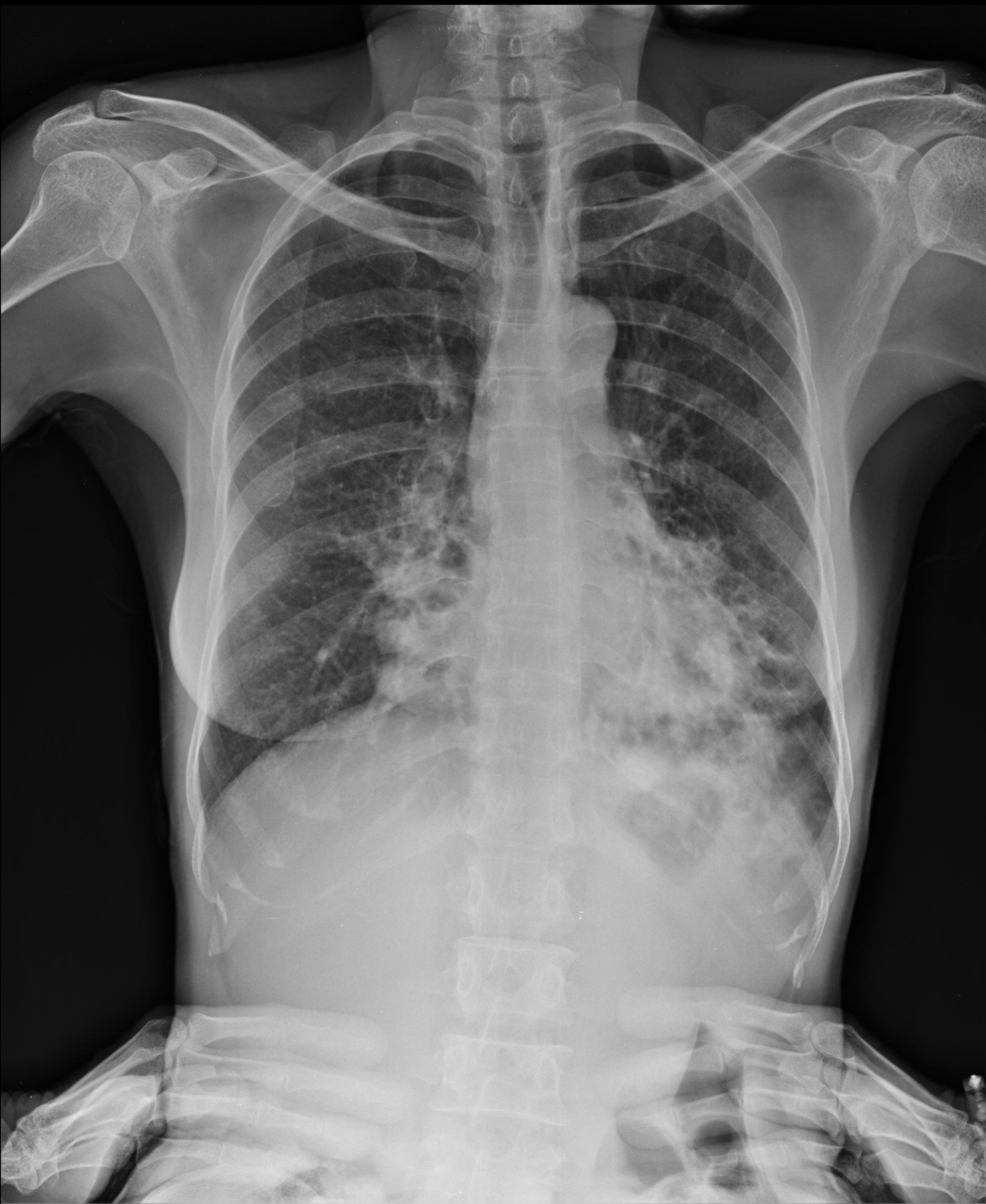 pediatric-bronchiectasis-background-pathophysiology-etiology-my-xxx