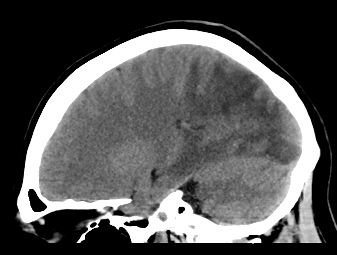 Subacute stroke | Image | Radiopaedia.org