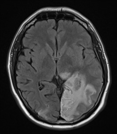 Subacute stroke | Image | Radiopaedia.org