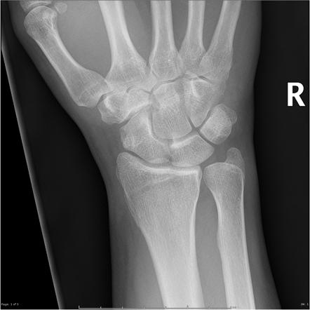 Scaphoid fracture - distal pole | Radiology Case | Radiopaedia.org