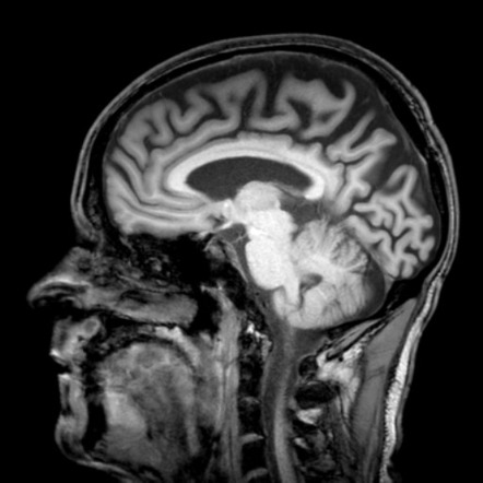 Huntington disease | Image | Radiopaedia.org