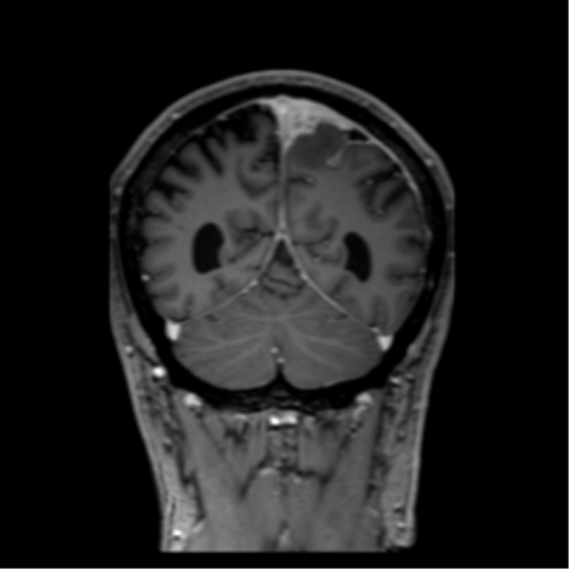 Pachymeningitis | Image | Radiopaedia.org