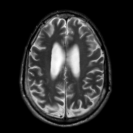 Pachymeningitis | Image | Radiopaedia.org