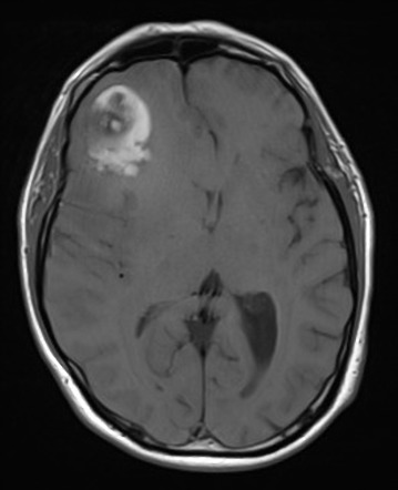 Viewing playlist: Parenchymal tumors | Radiopaedia.org