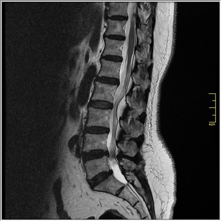 Epidural lipomatosis | Radiology Reference Article | Radiopaedia.org