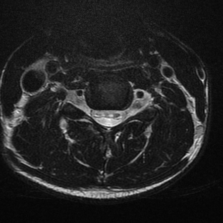 Hirayama disease | Image | Radiopaedia.org